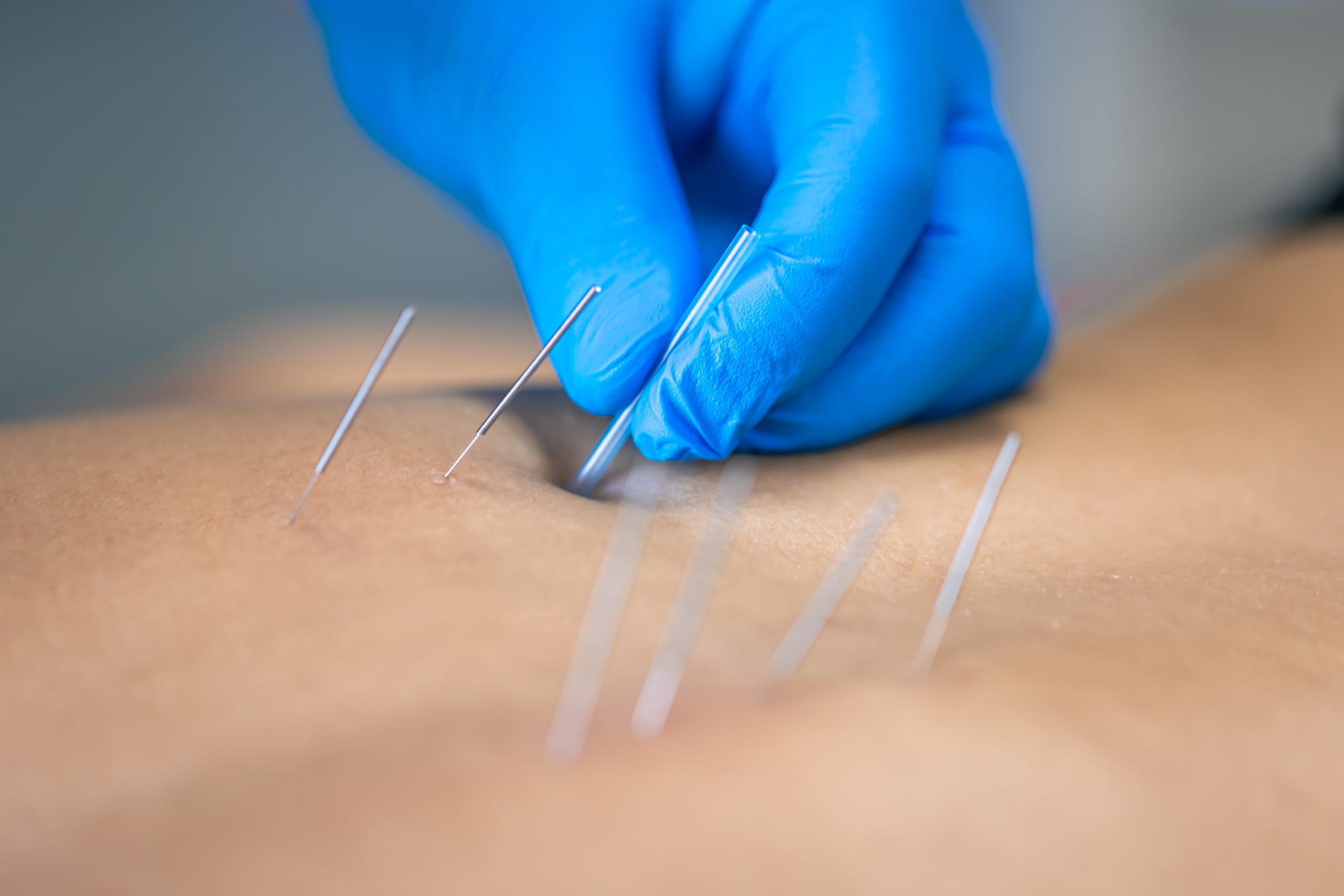 Dry needling has lasting analgesic effect in shoulder pain: a double-blind, sham-controlled trial