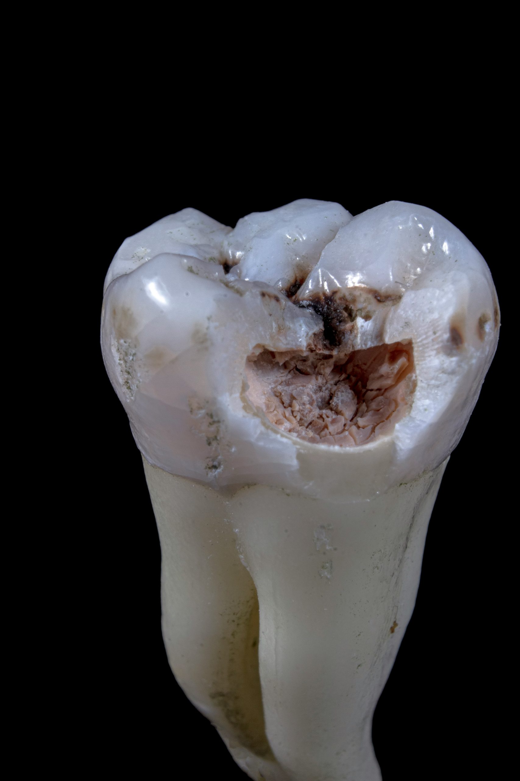 An evidence based update on management of impacted wisdom teeth